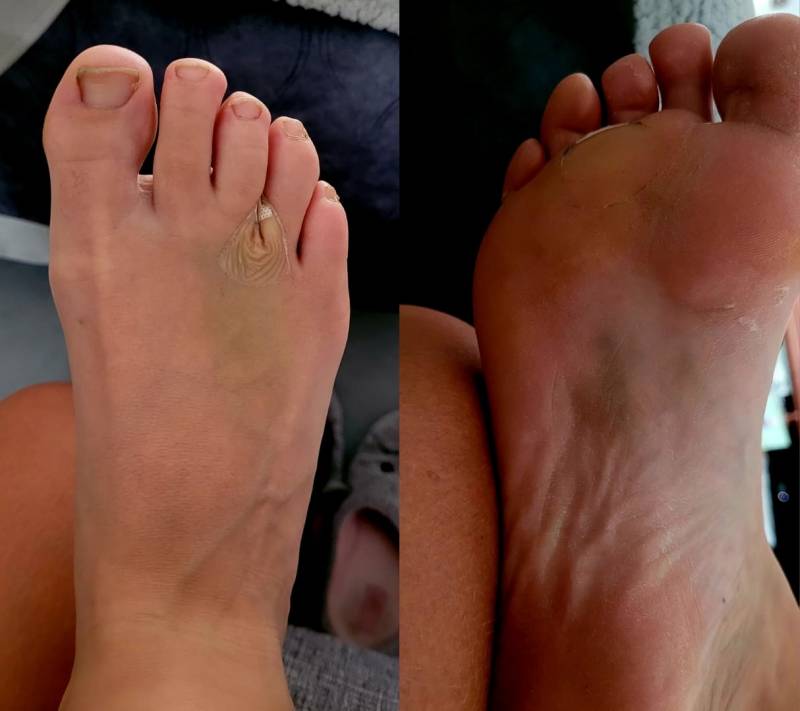 L’ecchymose au pied 3 jours après l’intervention.