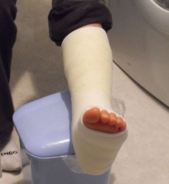 Traitement de la fracture de la cheville par un chirurgien près de Paris