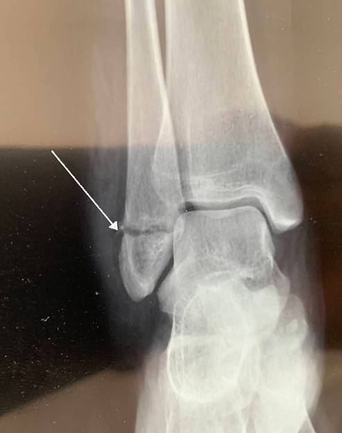 Traitement de la fracture de la cheville par un chirurgien près de Paris