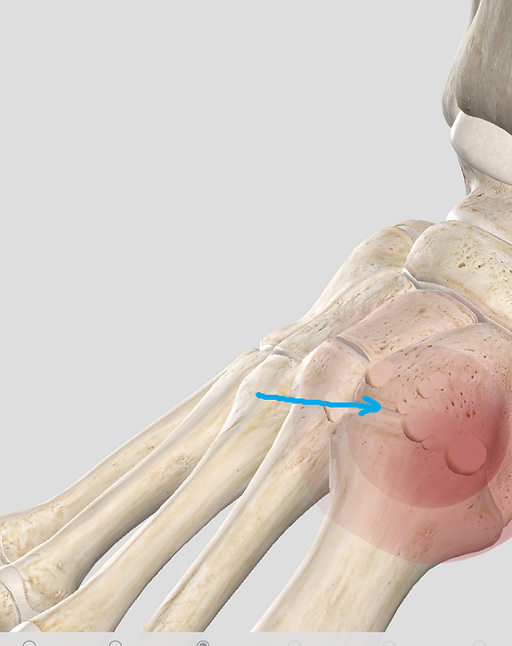 Infiltrations de corticoïdes pour soulager la douleur de l'arthrose du pied et de la cheville