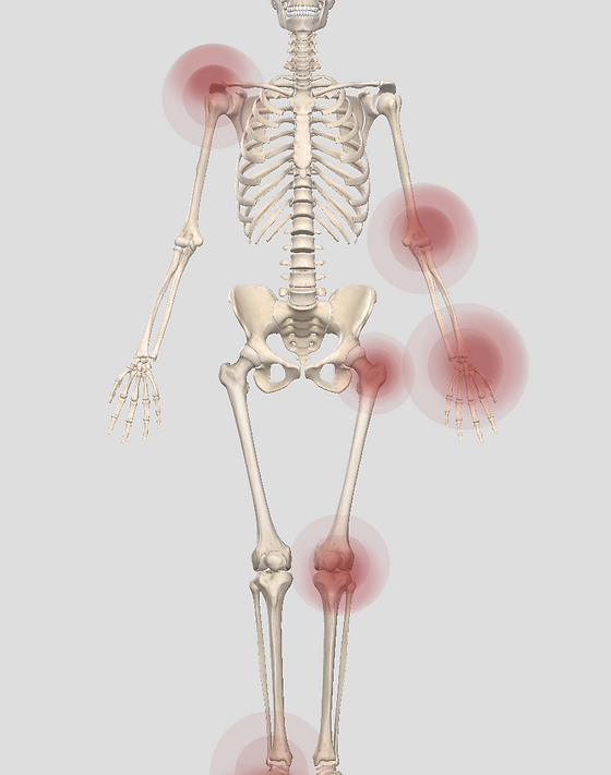 Infiltrations de corticoïdes : une solution efficace et peu invasive