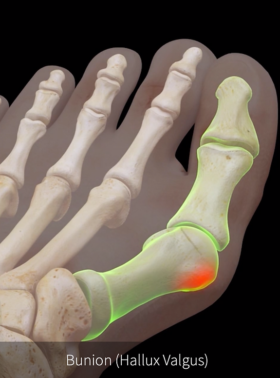 Traiter un Hallux Valgus avec un chirurgien spécialisé dans le pied à Paris