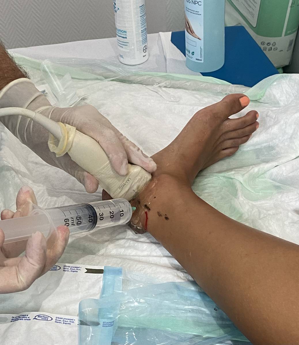 libération du nerf tibial en consultation