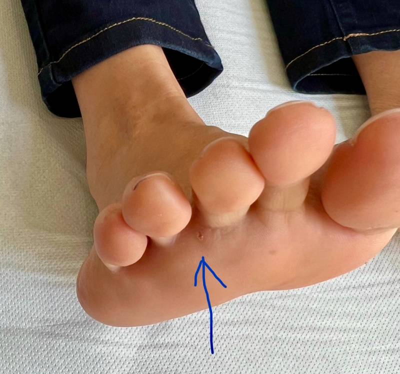 La cicatrice de l’intervention