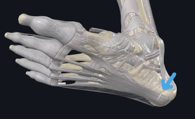 section de l'aponévrose plantaire au biseau d'une aiguille