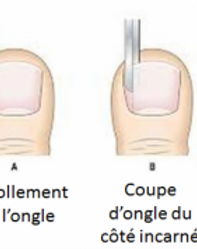 Chirurgie orthopédique pour un ongle incarné à Paris en Île-de-France