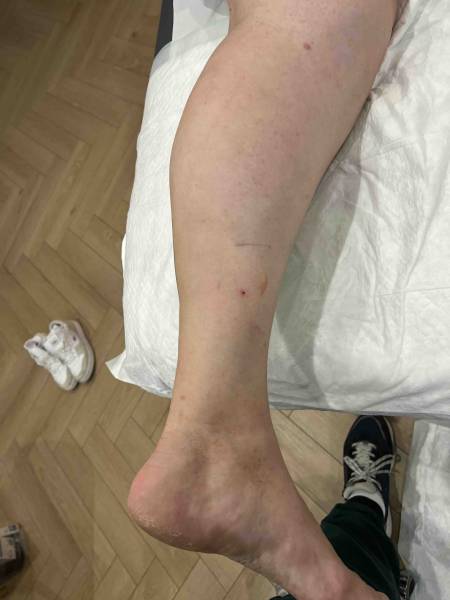 Cicatrice du mollet pour l’allongement de la lame des gastrocnémiens