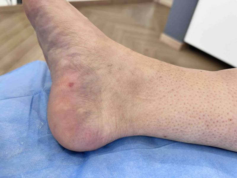 Cicatrice de la section de l’aponévrose plantaire