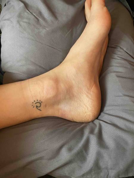 Cicatrices du tunnel tarsien gauche