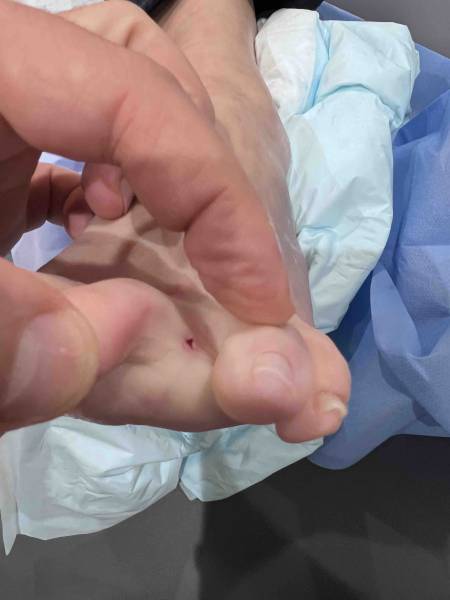 Cicatrice pour la libération du névrome de Morton