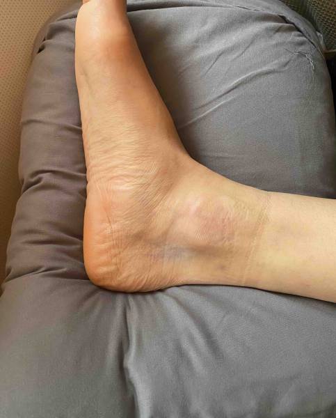 Cicatrices du tunnel tarsien droit