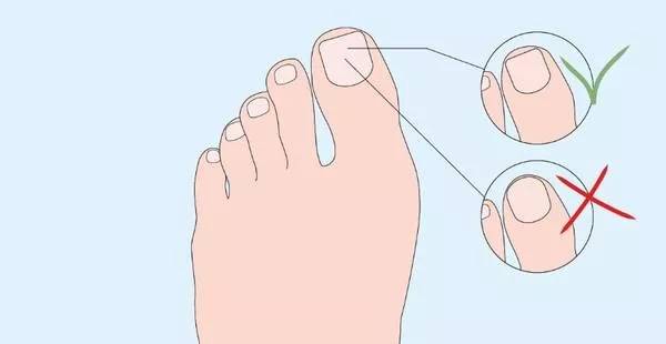 Comprendre, Prévenir et Traiter l’Ongle Incarné : Un Guide Complet