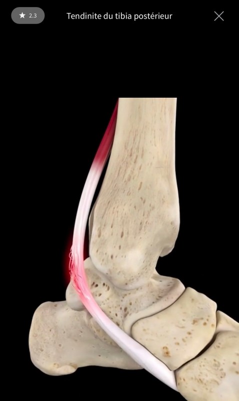 Les tendinopathies du pied, à Rueil-Malmaison