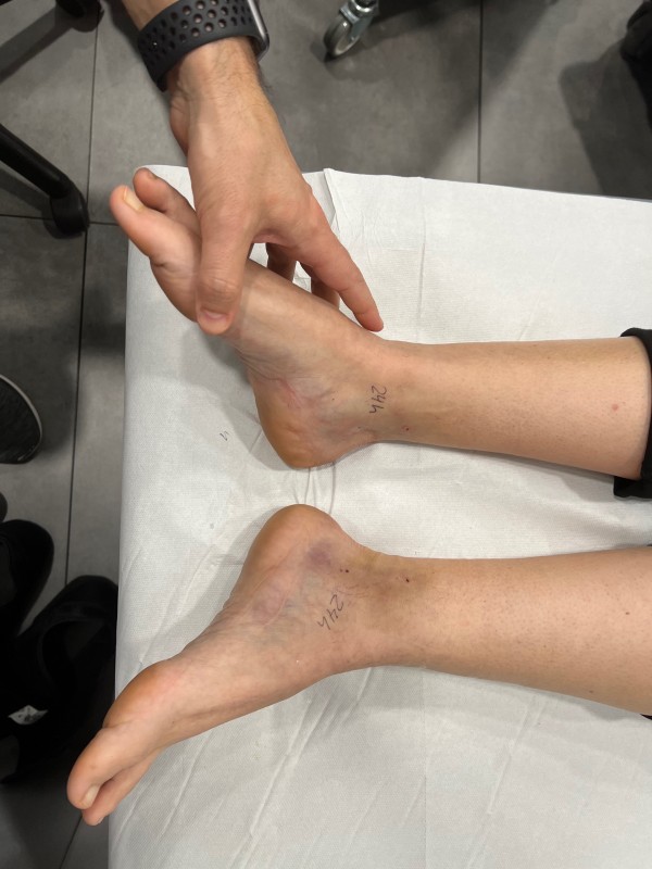 Le syndrome du tunnel tarsien, la décharge électrique dans le talon et la plante du pied, la soulager près de Paris.