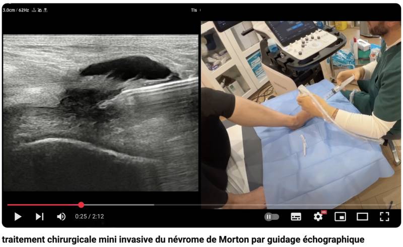 Video de la chirurgie