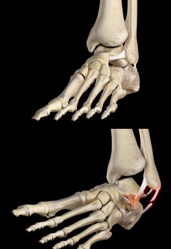 rupture des ligaments latéraux de la cheville