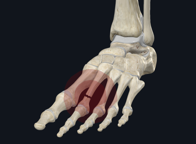 fracture de fatigue du 2e métatarsien
