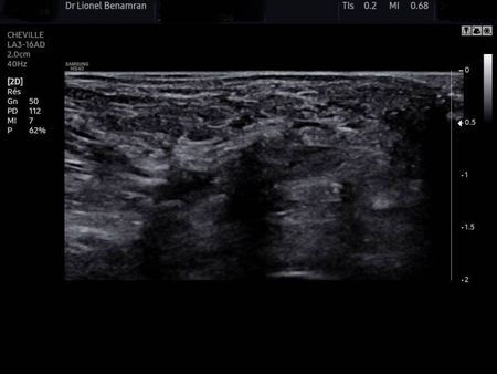 Notre zone d'activité pour ce service Trouver un chirurgien qui pratique l'échochirurgie pour traiter un névrome de Morton sans cicatrice