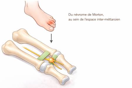 Notre zone d'activité pour ce service Comment soulager la douleur chronique à l'avant-pied grâce à un traitement chirurgical proposé par un expert
